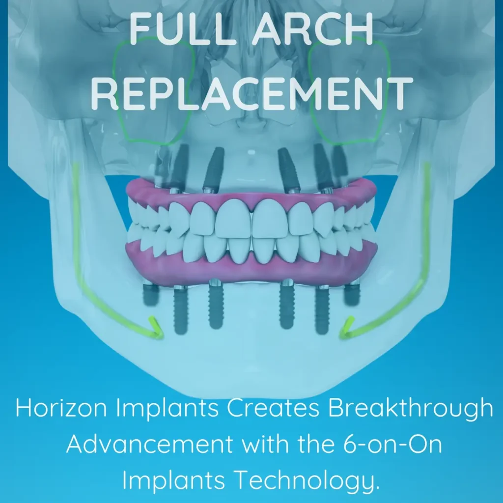 Horizon Implants- Thousand Oaks California USA