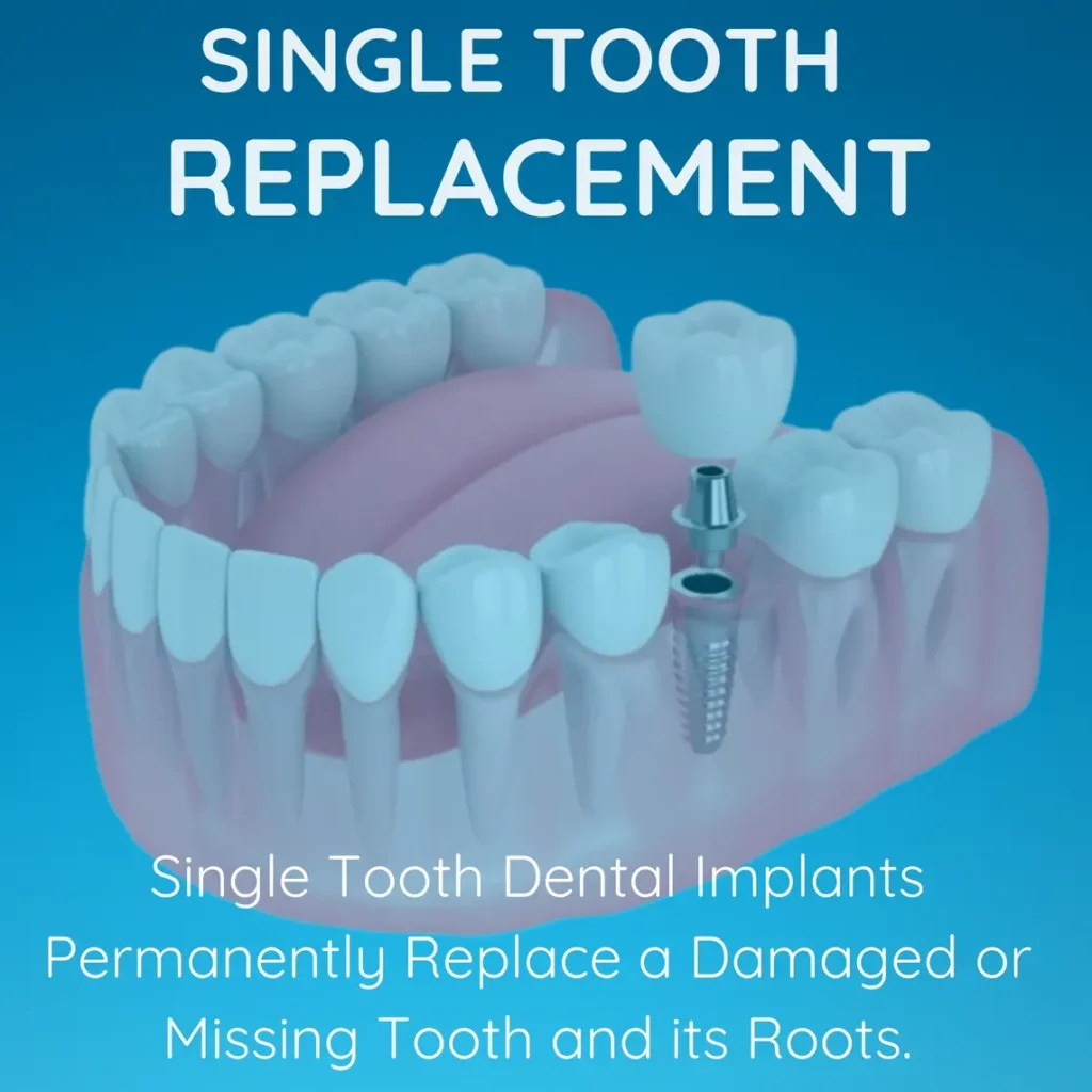 Horizon Implants Thousand Oaks California USA