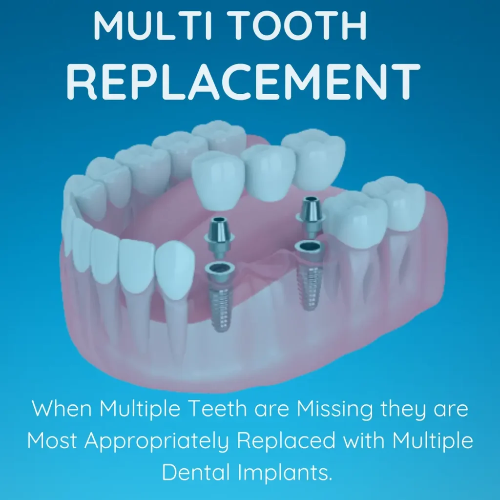 Horizon Implants Thousand - Oaks California USA