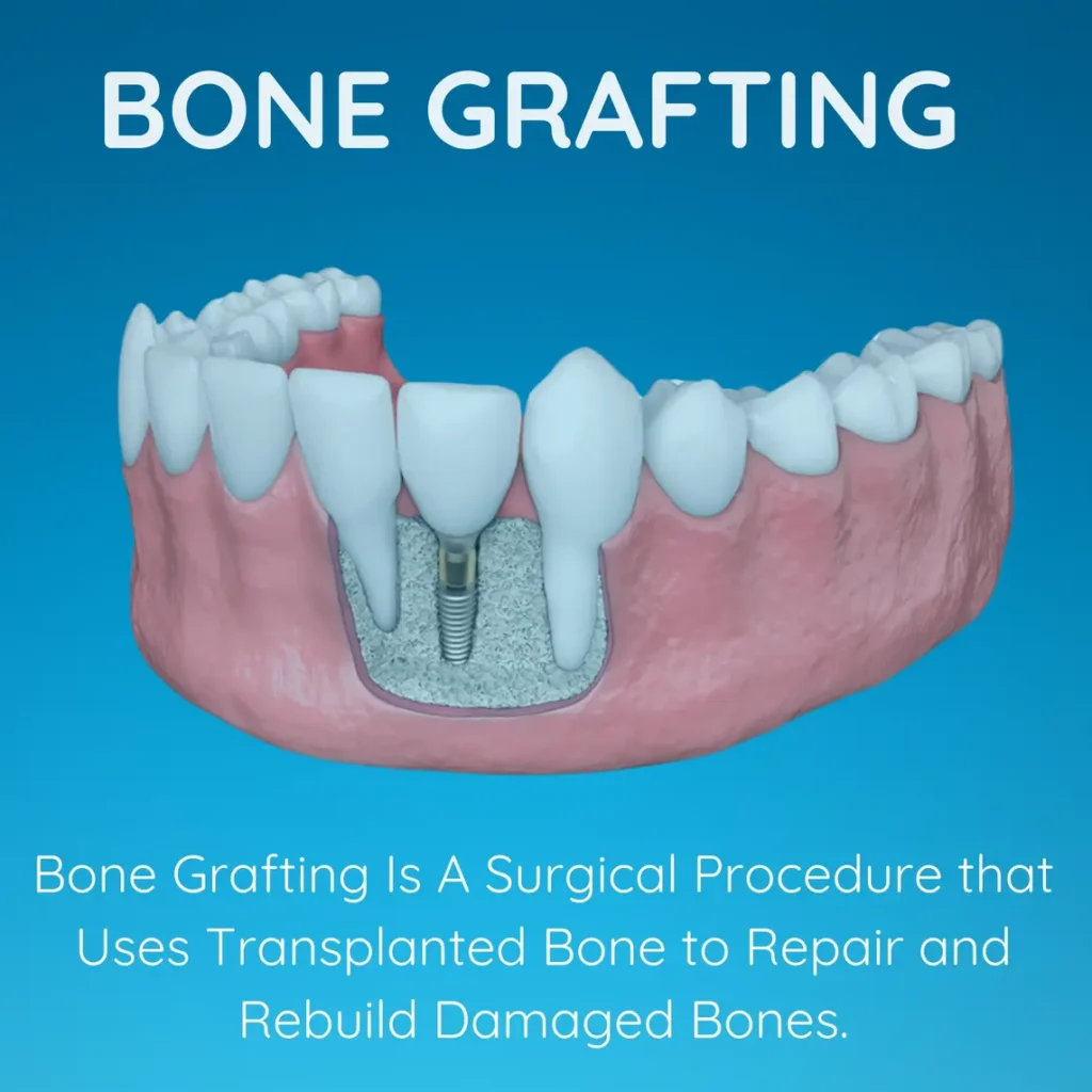 Horizon Implants Thousand Oaks - California USA