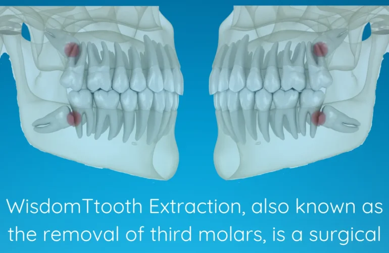 Wisdom Tooth Extraction