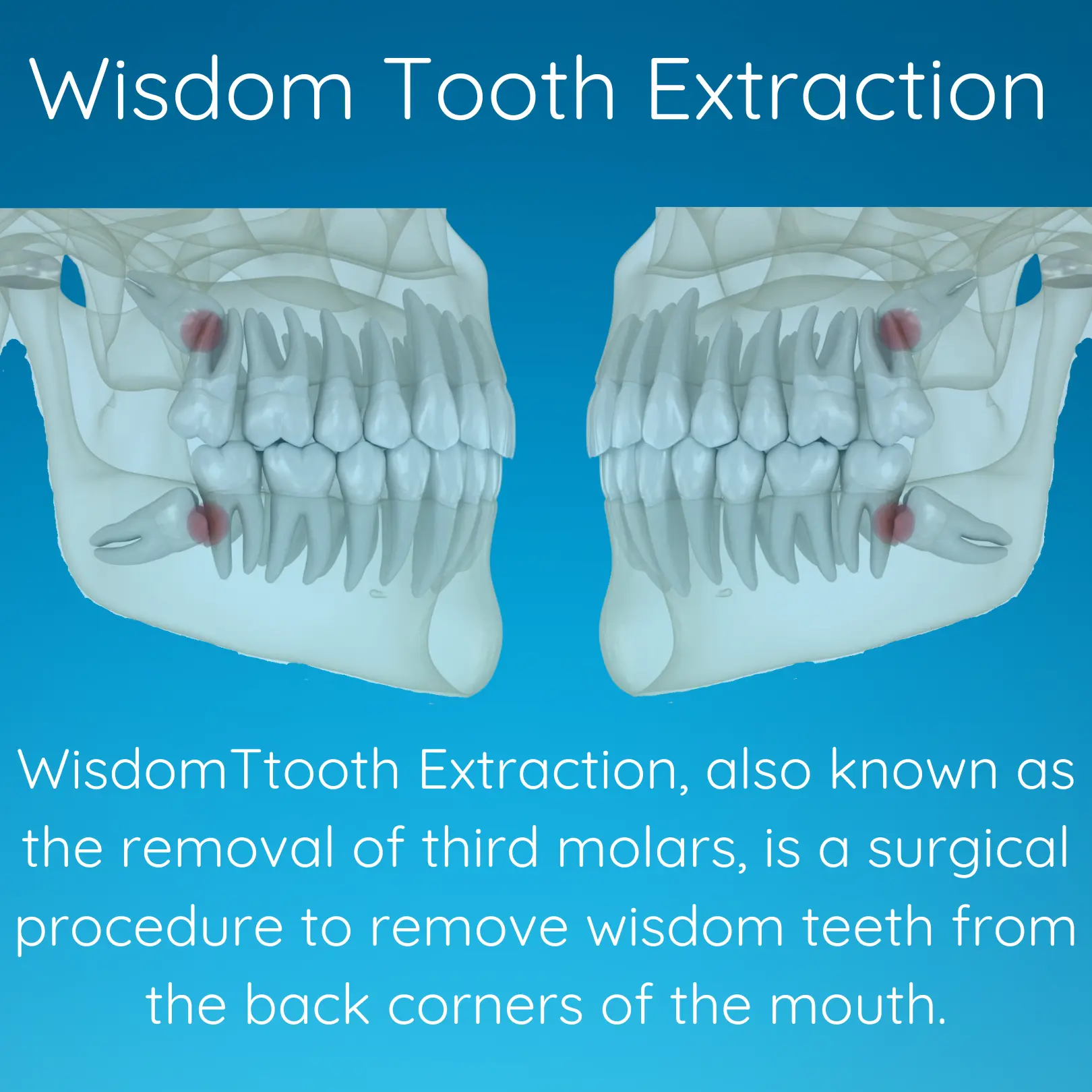 Wisdom Tooth Extraction