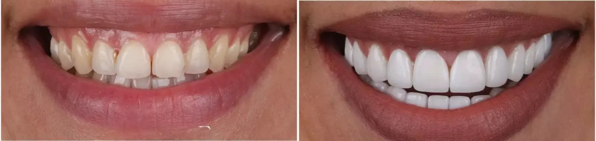 Hollywood Smile Horizon Implants in Thousand Oaks, CA