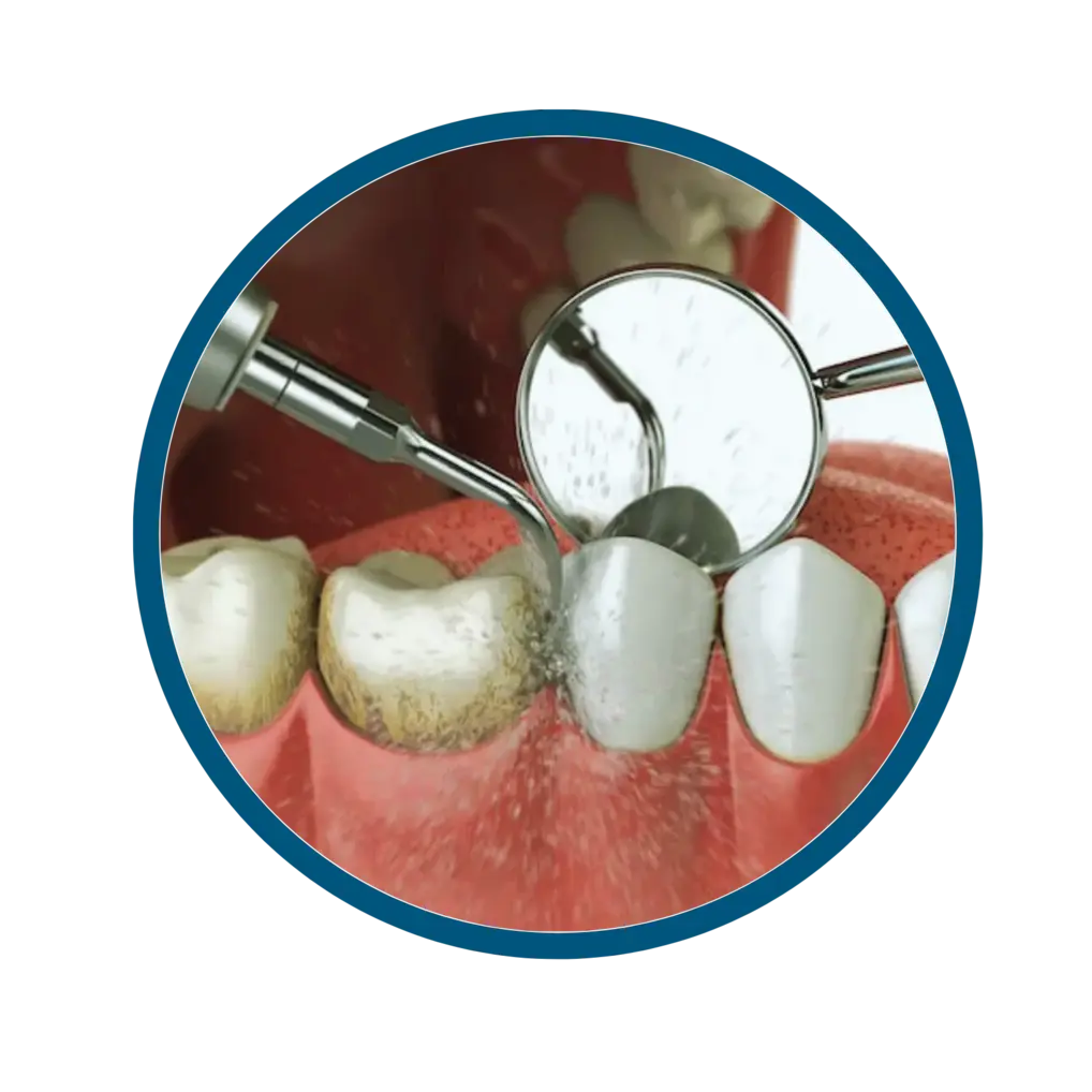 Dental crown being fitted on a prepared tooth in Oakland, CA