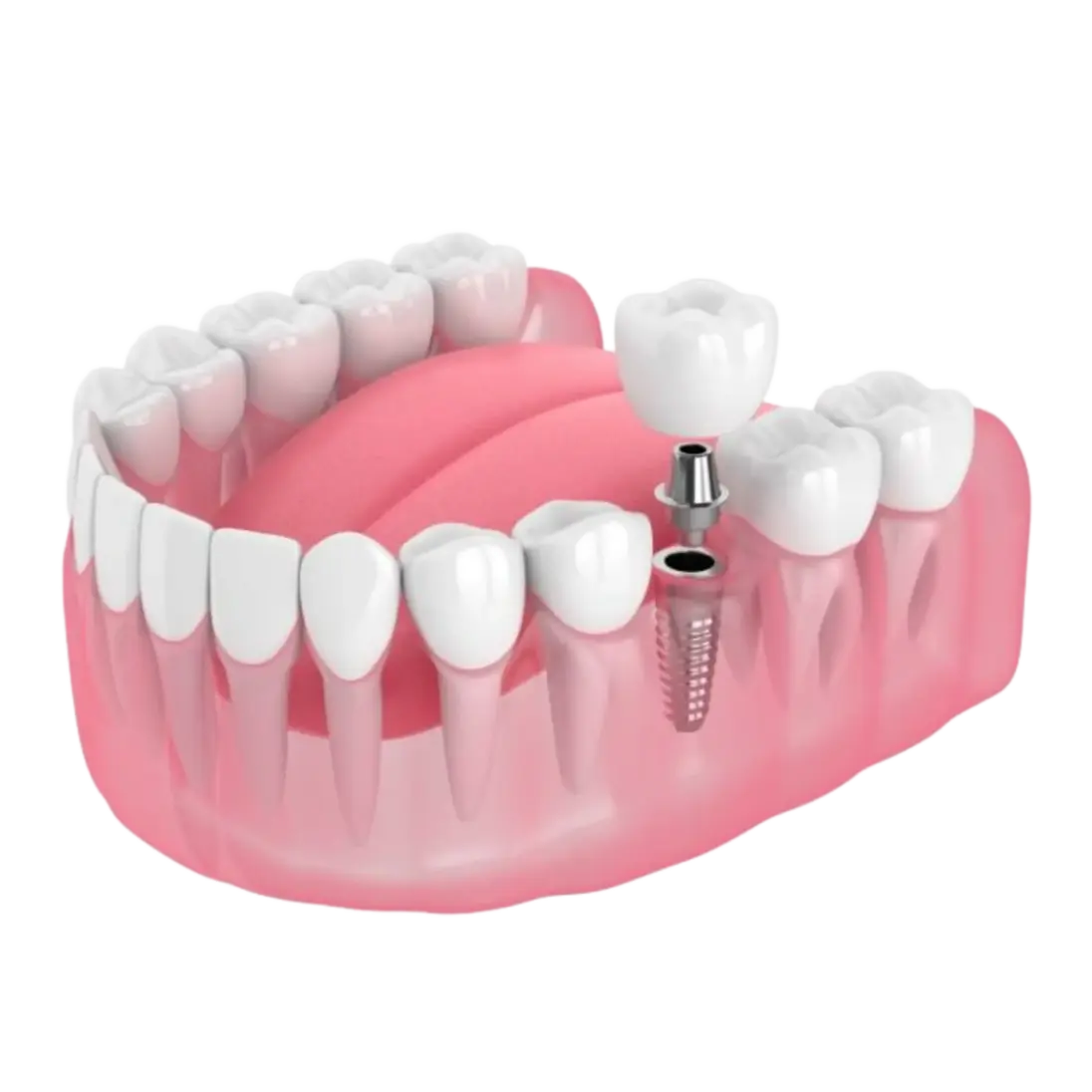 Dental implant placed in the jaw bone in Oakland, CA