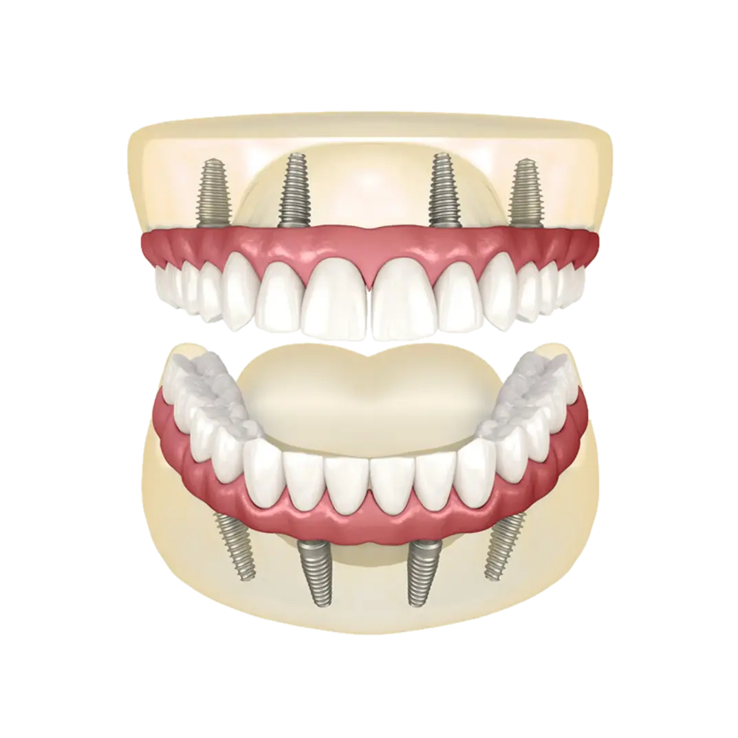 Full dentures replacing missing teeth in Oakland, CA