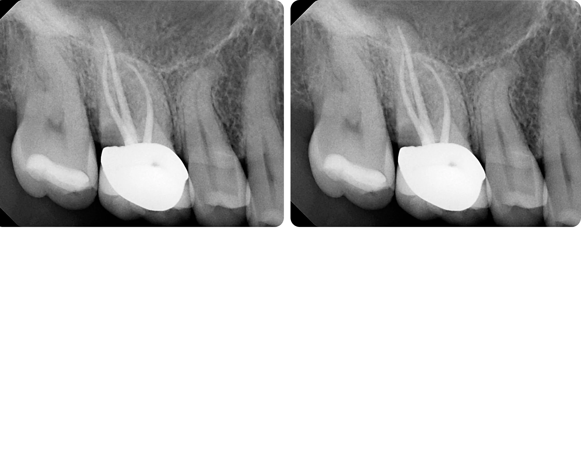 Healthy teeth after regular children dental care in Oakland, CA