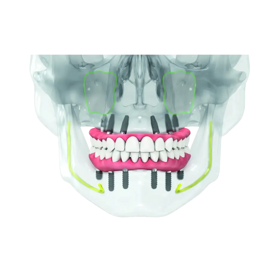 Clear aligner tray on a dental model in Oakland, CA