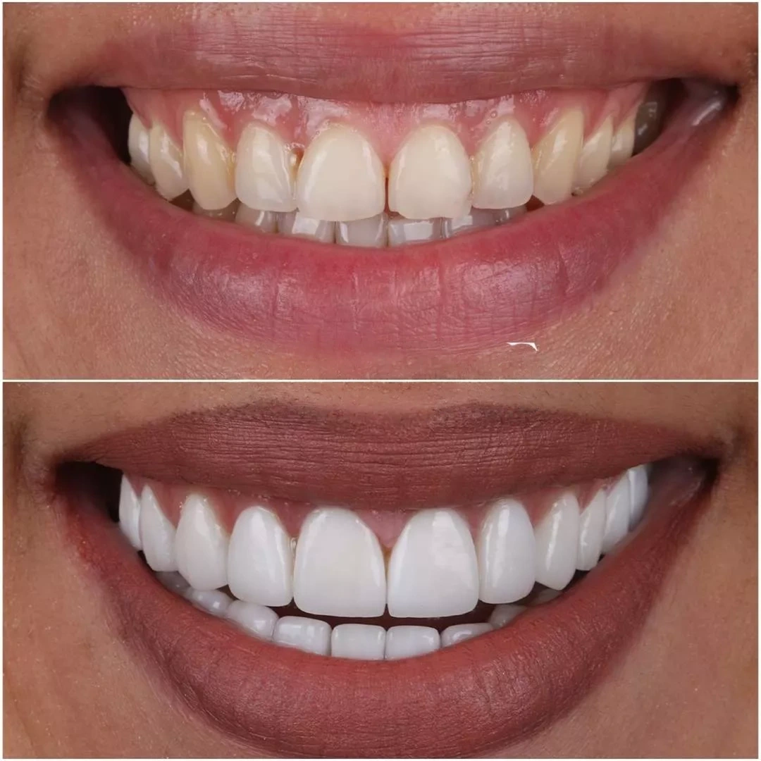 Teeth whitening shade guide in Oakland, CA